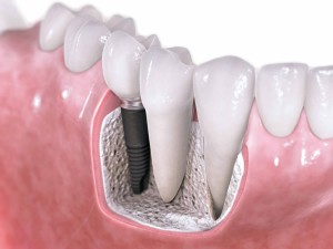 dental implants, arizona dentist