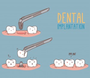 dental implants can stop bone loss