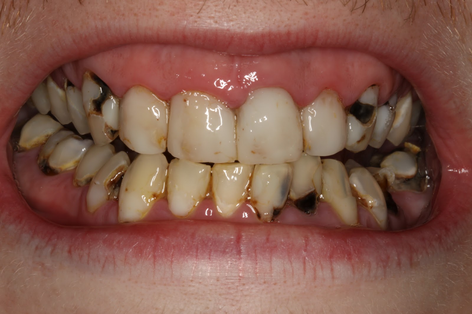 teeth-decay-jg1o9fpy.jpg
