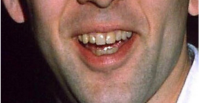 celebrity bad teeth