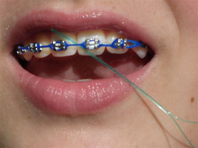 flossing with braces