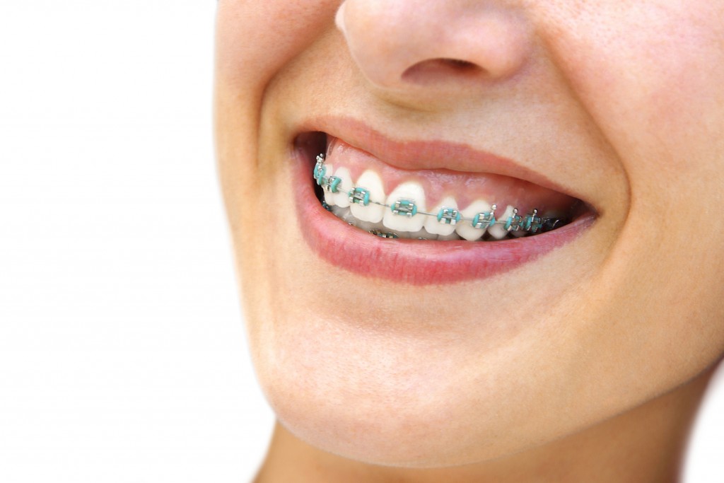 woman with braces
